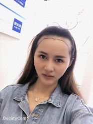 -大麦微针植发丨全国连锁