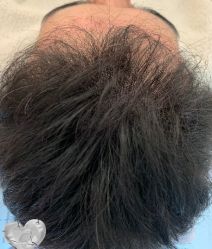 -大麦微针植发丨全国连锁