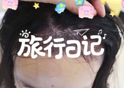 -大麦微针植发全国连锁