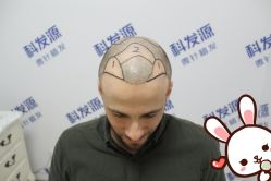 -大麦微针植发丨全国连锁