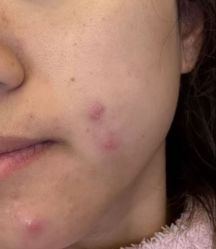 -倩极·精研痘敏肌管理