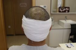 -大麦微针植发丨全国连锁