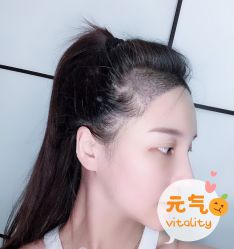 -大麦微针植发全国连锁