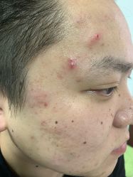 -荟草堂专业痘肌皮肤管理