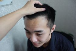 点击看大图 -大麦微针植发丨全国连锁