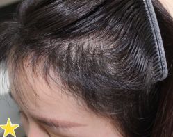 -大麦微针植发丨全国连锁