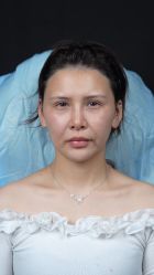 体验前-佛山曙光金子医学美容医院
