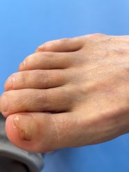 -足太医扦脚·灰指甲·嵌甲