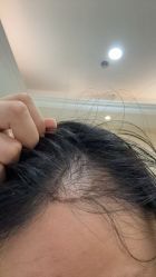 -碧莲盛·不剃发植发