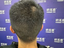 -碧莲盛·不剃发植发