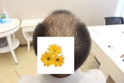 -大麦微针植发丨全国连锁