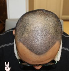 -大麦微针植发丨全国连锁