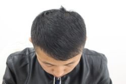 -大麦微针植发丨全国连锁