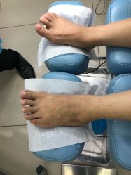 -派恩宜灰指甲鸡眼嵌甲手足癣