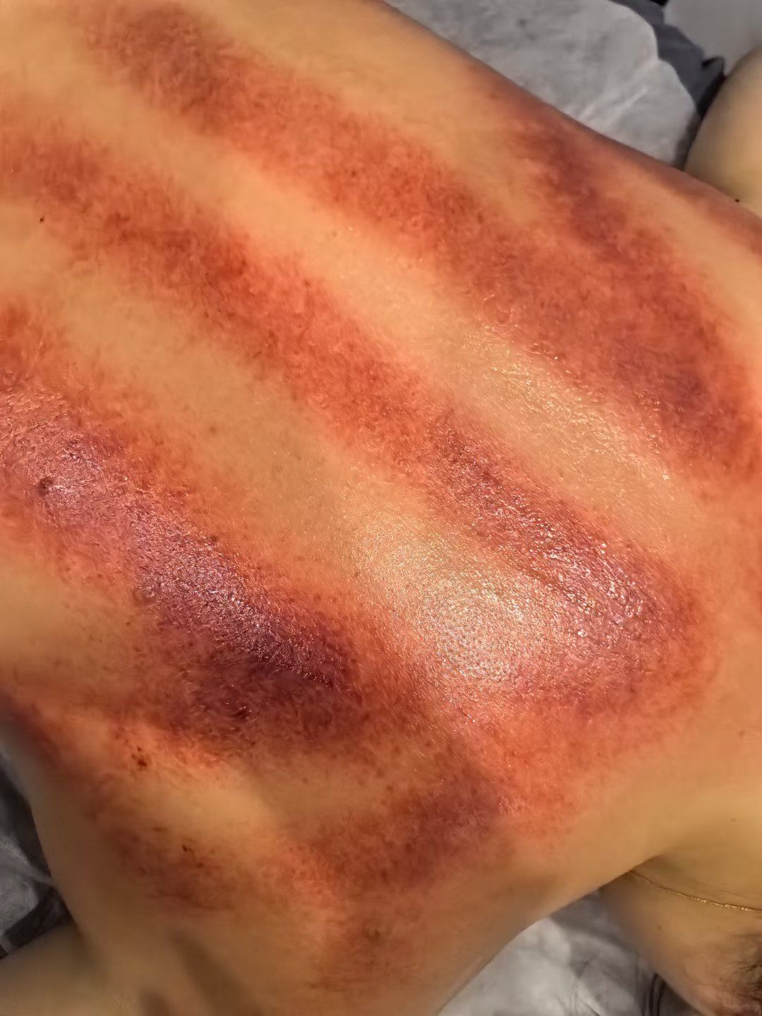 小姐姐最近肩背特别不舒服,看看这些黑痧印