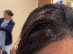 -碧莲盛·不剃发植发