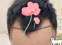 -大麦微针植发全国连锁