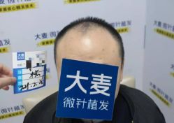 -大麦微针植发丨全国连锁