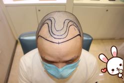 -大麦微针植发丨全国连锁