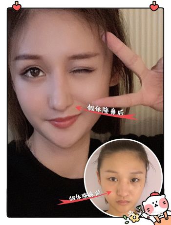 玻尿酸隆鼻与假体隆鼻哪种更好？