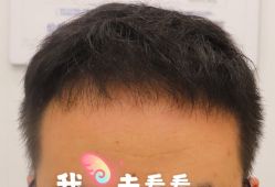 -大麦微针植发全国连锁