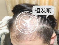 -大麦微针植发全国连锁