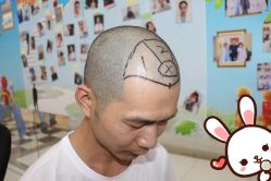 点击看大图 -大麦微针植发丨全国连锁