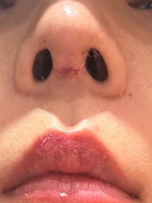 切口相对隐蔽,如果是比较精细的手术,比如肋软骨隆鼻,膨体隆鼻等,可能