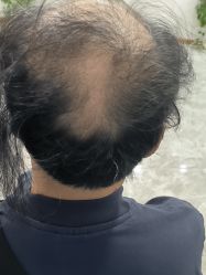点击看大图 -碧莲盛·不剃发植发