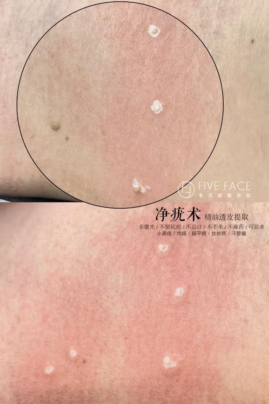 扁平疣这个问题真的要重视