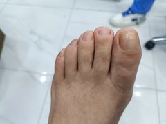 -Andrew指甲专科灰指甲·甲沟炎矫正·3D步态矫形鞋垫定制(浦三路店)