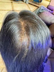 -碧莲盛·不剃发植发