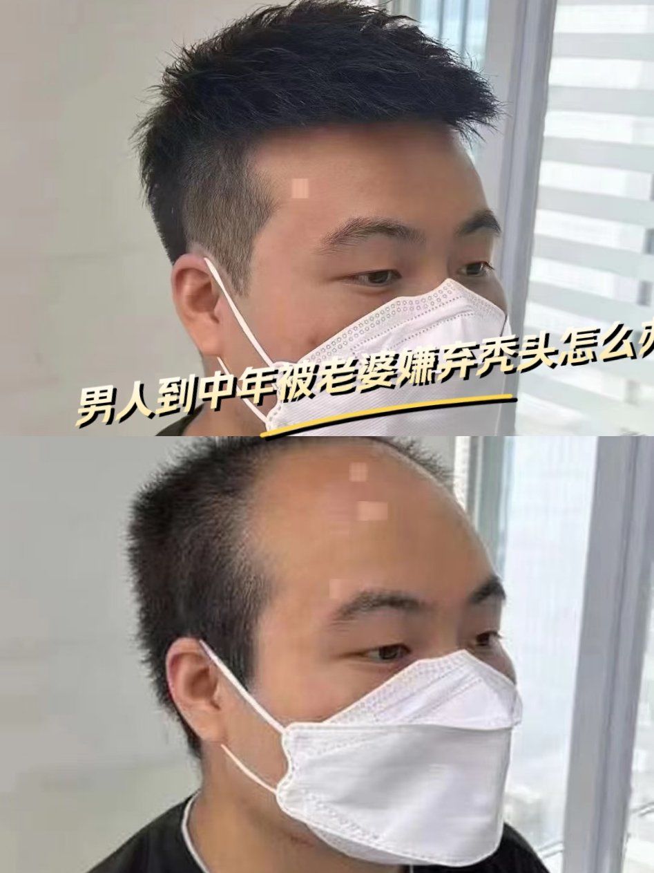 男人到中年秃头,每天都被老婆嫌弃
