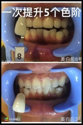 光SPA牙齿美白-光SPA科技美肤