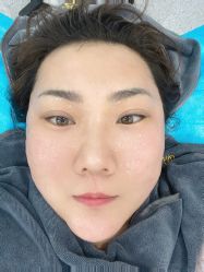 体验后-More摩尔医美の注射线雕光电中心