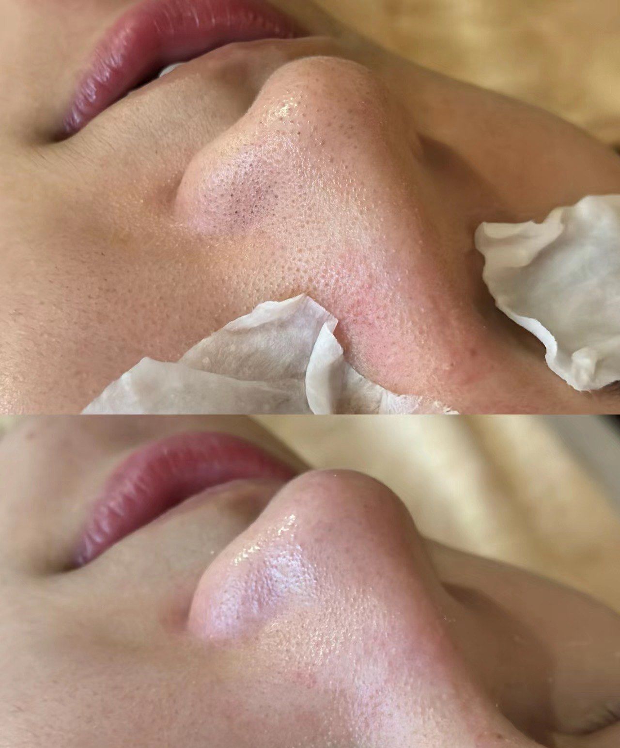 清洁毛孔大作战