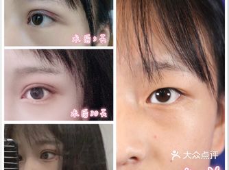 双眼皮术后修复必备指南疤痕体质看过来️