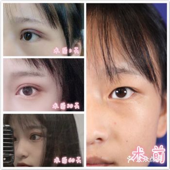 双眼皮术后修复必备指南疤痕体质看过来️