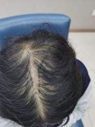 -大麦微针植发丨全国连锁