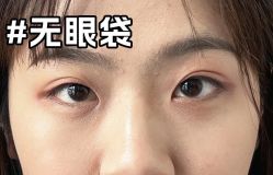 -广州健丽·去眼袋医疗美容机构