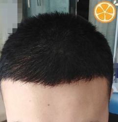 -大麦微针植发丨全国连锁