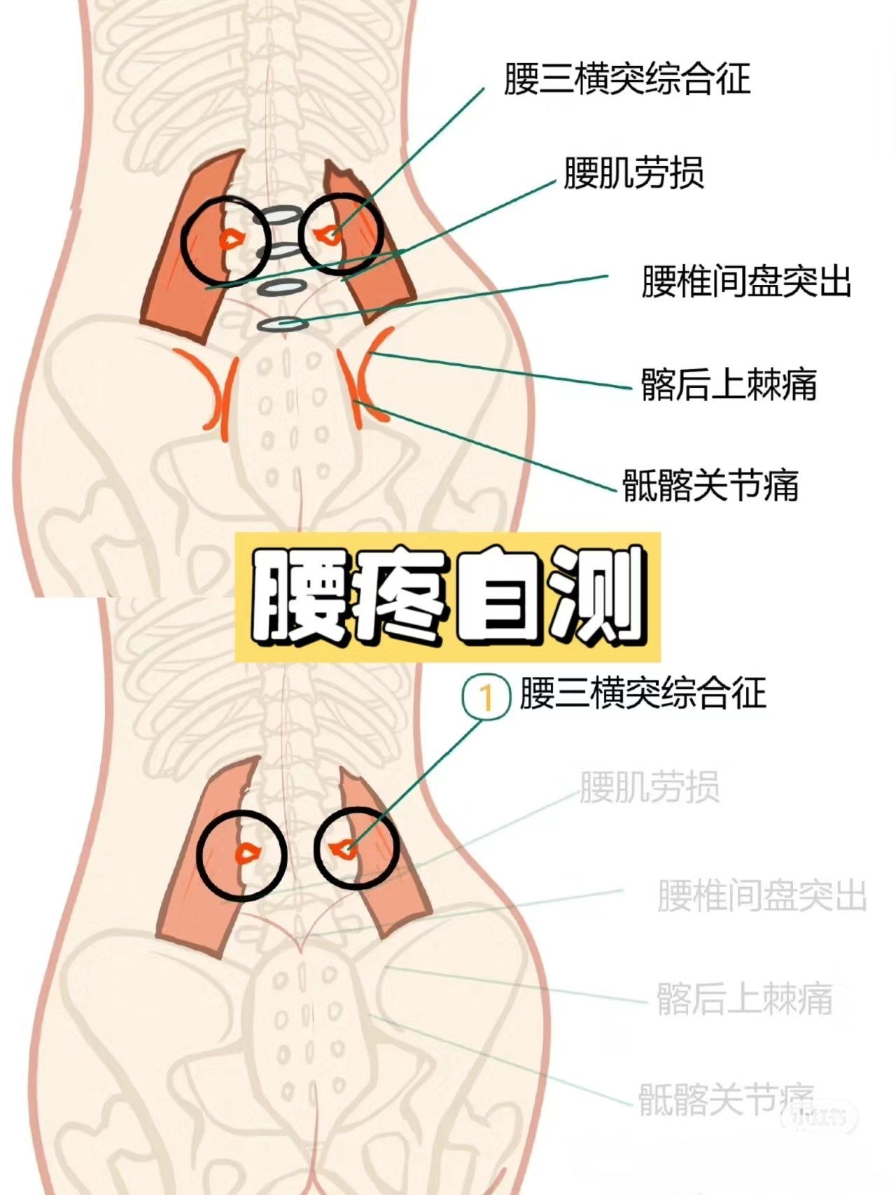 n腰往前弓着容易造成骨盆前倾,腰椎间盘突出\n①避免长时间的久坐