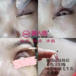 -美人痣全国连锁