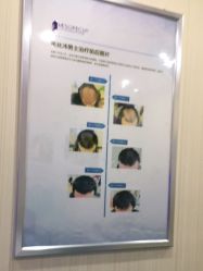 -碧莲盛·不剃发植发
