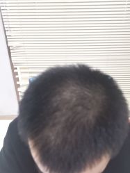 -大麦微针植发丨全国连锁