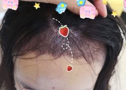 -大麦微针植发全国连锁