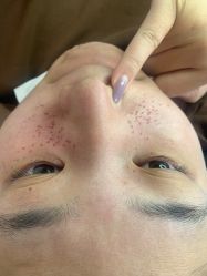 -美丽人生祛斑扁平疣汗管瘤中心