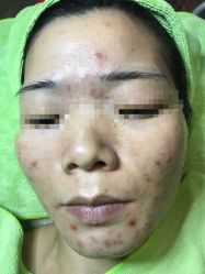 -苗医生草本科技祛痘