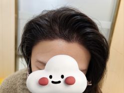-碧莲盛·不剃发植发