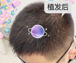 -大麦微针植发全国连锁